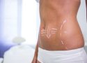 Pourquoi choisir la cryolipolyse à Cannes pour affiner sa silhouette ?